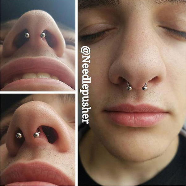 Does Fixing A Deviated Septum Change The Shape Of Your Nose