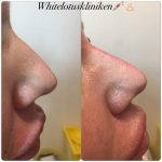 Dorsal Hump Nose Surgery (1)