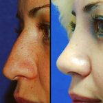 During Hooked Nose Rhinoplasty, A Plastic Surgeon Sculpts The Cartilage And Bone Of The Nose