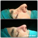 Fix Deviated Septum During Rhinoplasty Picture