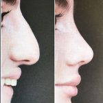 Hooked Nose Job Before And After (1)