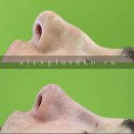 Hooked Nose Job Photos (4)