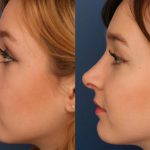 Hooked Nose Operation Photo Before And After