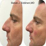Hooked Nose Plastic Surgery For Man