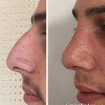 Hooked Nose Rhinoplasty Before And After Pictures (4)
