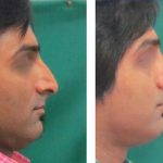 Hooked Nose Rhinoplasty For Man