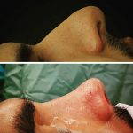 Hooked Nose Rhinoplasty Is The Most Common Type Of Rhinoplasty Performed