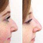Hooked Nose Rhinoplasty To Achieve A Patient's Desired Look
