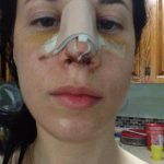 How Is Septoplasty Performed Photo