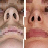 Ideal Nose Width After Nostril Surgery
