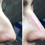 Is Fixing A Deviated Septum A Nose Job