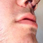 Male Model Nose Job (1)