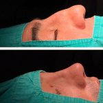 Male Nose Job Before And After Photos (1)