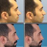 Male Nose Job Before And After Photos (12)