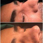 Male Nose Job Before And After Photos (5)
