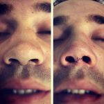 Male Nose Job Before And After Photos (7)
