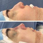 Male Rhinoplasty Pictures (3)