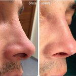 Male Rhinoplasty Pictures (4)