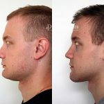 Male Rhinoplasty Pictures (5)