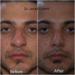Male Rhinoplasty Procedure Before And After (1)