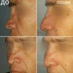 Male Rhinoplasty Procedure Before And After (6)
