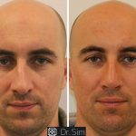 Male Rhinoplasty Procedure Before And After (8)