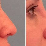 Non Surgical Nose Reshaping With Radiesse (1)