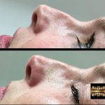 Non Surgical Nose Reshaping With Radiesse (3)