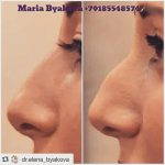 Non Surgical Nose Reshaping With Radiesse (4)