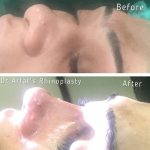 Nose Bump Bridge Before And After (3)