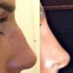Nose Bump Deviated Septum Before And After Photos (1)