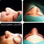 Nose Bump Plastic Surgery Photos (1)