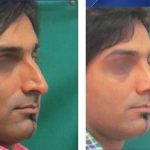 Nose Bump Plastic Surgery Photos (3)