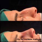 Nose Bump Plastic Surgery Photos (4)