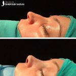 Nose Bump Plastic Surgery Photos (5)