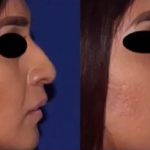 Nose Bump Plastic Surgery Starts With An Incision At The Base Of The Nose