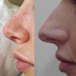 Nose Bump Removal Photos (1)