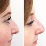 Nose Bump Removal Photos (3)
