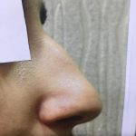Nose Bump Removal Surgery Depends On The Size Of The Dorsal Hump