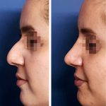 Nose Bump Surgery Before And After