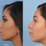 Nose Bump Surgery Before And After (2)