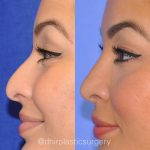 Nose Bump Surgery Before And After (3)