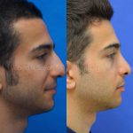 Nose Bump Surgery For Man (1)