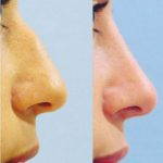 Nose Bump Treatment