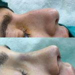 Nose Job Bump Removal Before And After (4)