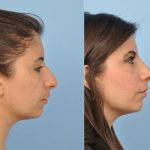 Nose Job For Hooked Nose