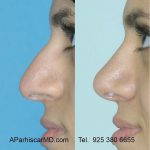 Nose Surgery For Bump Photos (5)