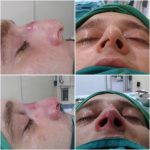 Nose Surgery Hump Removal Closed Rhinoplasty Photos (2)