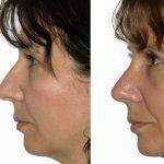 Nose Surgery To Remove Bump Pictures (2)