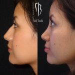 Nose Surgery To Remove Bump Pictures (4)